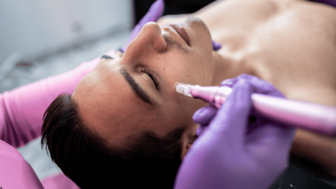 Microneedlingbehandling i ansiktet med dermapen utförd av professionell behandlare, närbild som illustrerar resultat, hudförbättring och om microneedling är värt pengarna