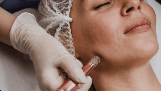 Microneedling-behandling på käklinje med dermapen, utförd av behandlare med handskar, som stimulerar kollagen och hudförnyelse under läkningsprocessen